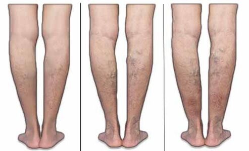 The phases of the vein with varicose