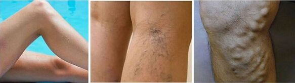 The appearance of varicose veins in the legs