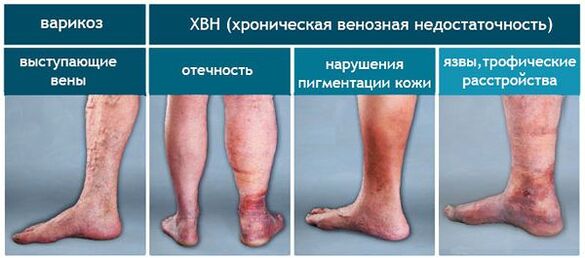 The phases of the vein with varicose
