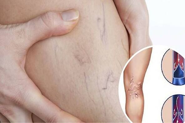 picture of the varicose veins