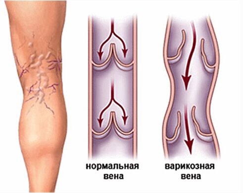 varicose veins