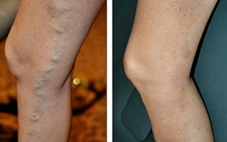 Varicose veins before and after