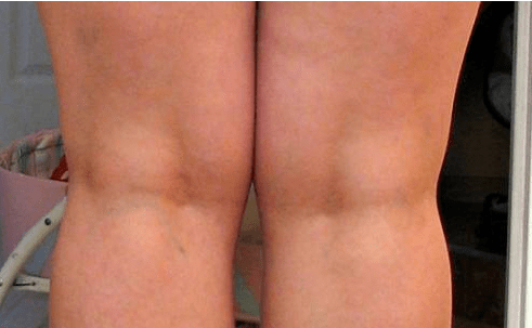 Varicose