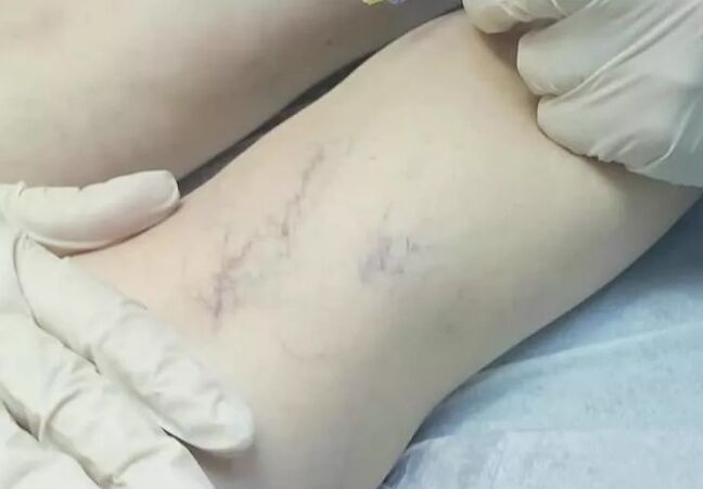 Post -operative complications