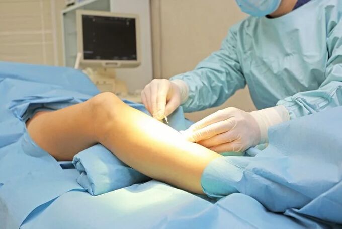The operation for removing the veins in the foot