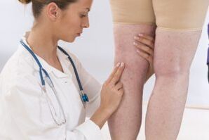 Flebologist examines the patient with varicose veins