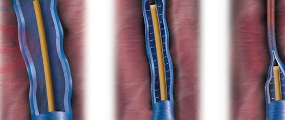 the essence of radiofrequency ablation in the treatment of varicose veins